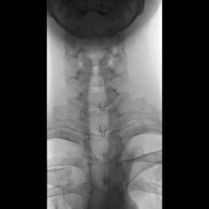 Túi thừa thực quản