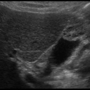 U cơ tuyến túi mật