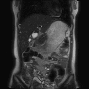 Nang ống mật chủ