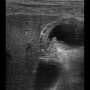 U cơ tuyến túi mật