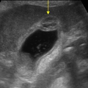 U cơ tuyến túi mật