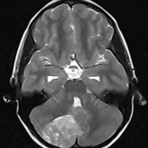 U nguyên bào tủy