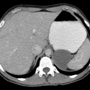 Nang ruột đôi dạ dày