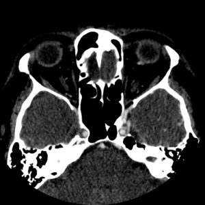 Rò động mạch cảnh xoang hang