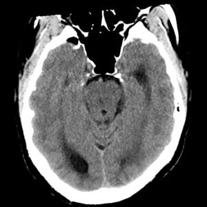 Di căn tuyến tùng