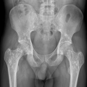 Xương đặc đốm