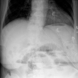 Thoát vị thành bụng