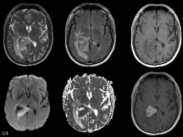 Lymphoma não