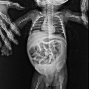 Giãn đại tràng bẩm sinh