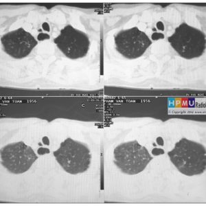 Túi thừa thực quản