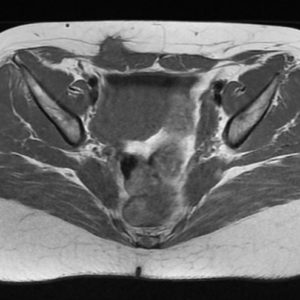 Lạc nội mạc tử cung