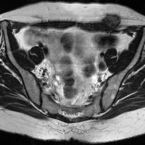 Lạc nội mạc tử cung