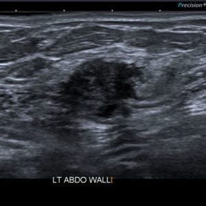 Lạc nội mạc tử cung