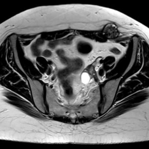 Lạc nội mạc tử cung