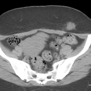 Lạc nội mạc tử cung