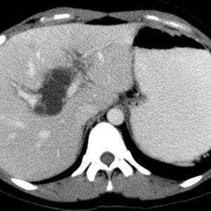 Nang ống mật chủ