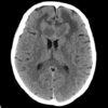 Lymphoma não - Hình ảnh 2