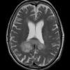 Lymphoma não - Hình ảnh 2