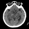 Lymphoma - Hình ảnh 2