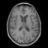 Lymphoma - Ảnh 2
