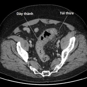 Viêm túi thừa đại tràng