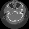 Cholesteatoma - Hình ảnh 2