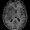 Lymphoma não - Hình ảnh 2