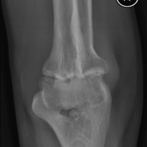 U sụn màng hoạt dịch