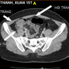 Viêm túi thừa - Hình ảnh 2