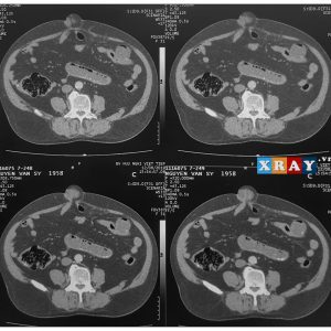 Thoát vị thành bụng