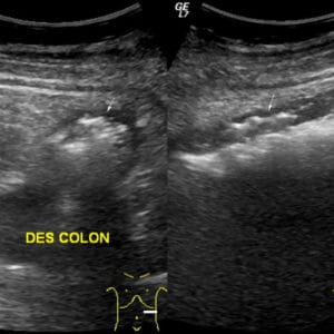 Viêm loét đại tràng