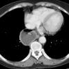 Achalasia - Hình ảnh 3