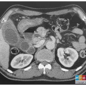 U cơ tuyến túi mật