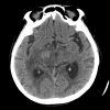 Lymphoma - Hình ảnh 3