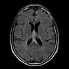 Lymphoma - Ảnh 3