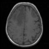 Lymphoma - Ảnh 4