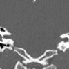 Cholesteatoma - Hình ảnh 3