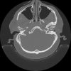 Cholesteatoma - Hình ảnh 3