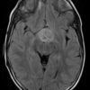 Glioma dưới đồi - Hình ảnh 3