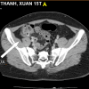 Viêm túi thừa - Hình ảnh 3