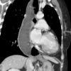 Achalasia - Hình ảnh 4