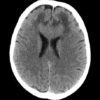 Lymphoma não - Hình ảnh 4