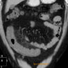 Crohn - Hình ảnh 3