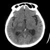 Lymphoma - Hình ảnh 4