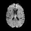 Lymphoma - Ảnh 4