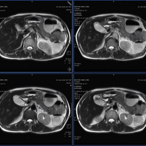 U cơ tuyến túi mật