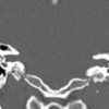 Cholesteatoma - Hình ảnh 4