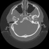 Cholesteatoma - Hình ảnh 4