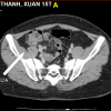 Viêm túi thừa - Hình ảnh 4