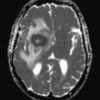 Lymphoma não - Hình ảnh 4